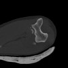 SPORK, NICO - 22.03.1976 - 02.08.2022 - CT obere Extremität - 18:02:23